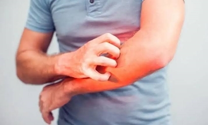 پشت‌پرده کهیر؛ از هشدار درباره آنافیلاکسی تا پرهیز از رژیم‌های غذایی خودسرانه